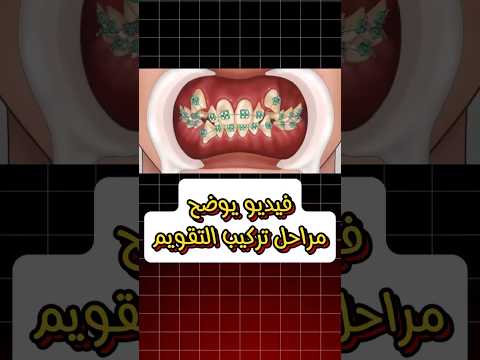 فيديو يوضح مراحل تركيب تقويم الاسنان بالتفصيل اعرف ازاي بنركب وبنشد التقويم بالضبط