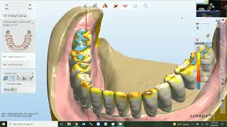 Effective Design Tips for the Modern Lab: Dentures and Abutment Split Files