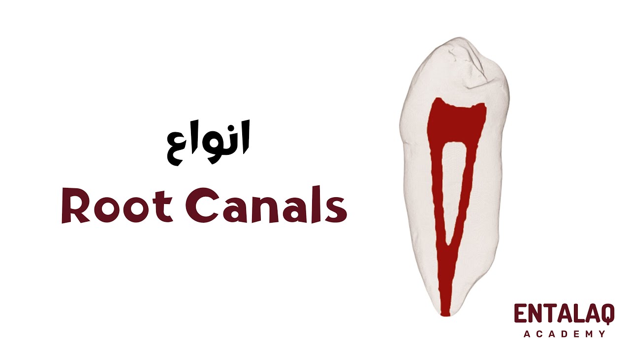 Root Canal Types Weine s Classification YouTube Root Canal Types Weine s Classification YouTube