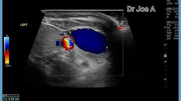 Internal jugular vein dilation: phlebectasia- bilateral : ultrasound and color Doppler video