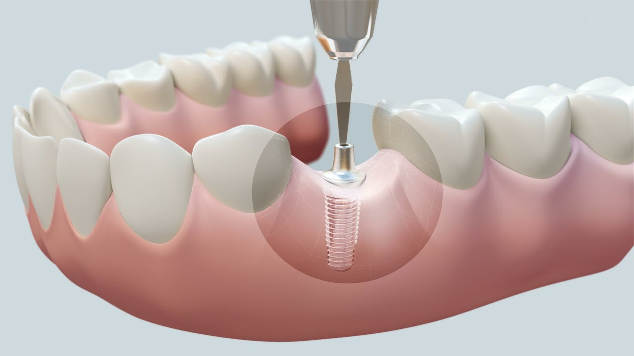 Dental Implants in Ramsey New Jersey (AV Dental Associates)