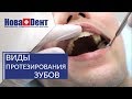 Протезирование зубов при полной потере. 🔬 Варианты протезирования при полной потере зубов. НоваДент