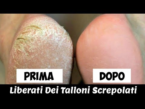 Rimedi Fai Da Te Per Rimuovere I Talloni Screpolati In Una Sola Notte - Ottimi Risultati