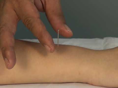 针灸入门\38.作用于经脉腧穴的辅助针刺手法--搓法