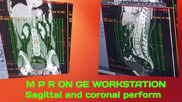 How to do Coronal and sagittal on GE Workstation // Reformatting perform on GE.