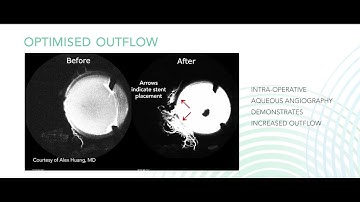 iStent inject W Booth Video