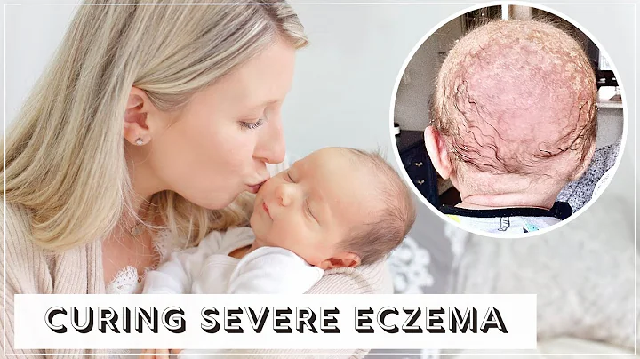 HOW I HEALED BABY ECZEMA OVERNIGHT! *SHOCKING RESULTS* | Eczema Products & Routine | Taylor Lindsay - DayDayNews