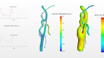FSI Simulation of Carotid Artery