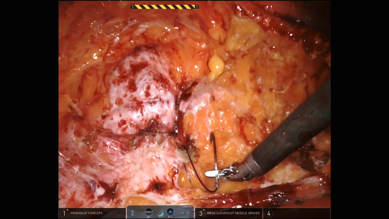 Robotic Paramedian Posterior Rectus Release (RPPRR)