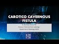 CAROTICO CAVERNOUS FISTULA