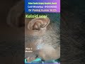Laser treatment of keloid| Keloid treatment in Ranchi | Best treatment of keloid acar
