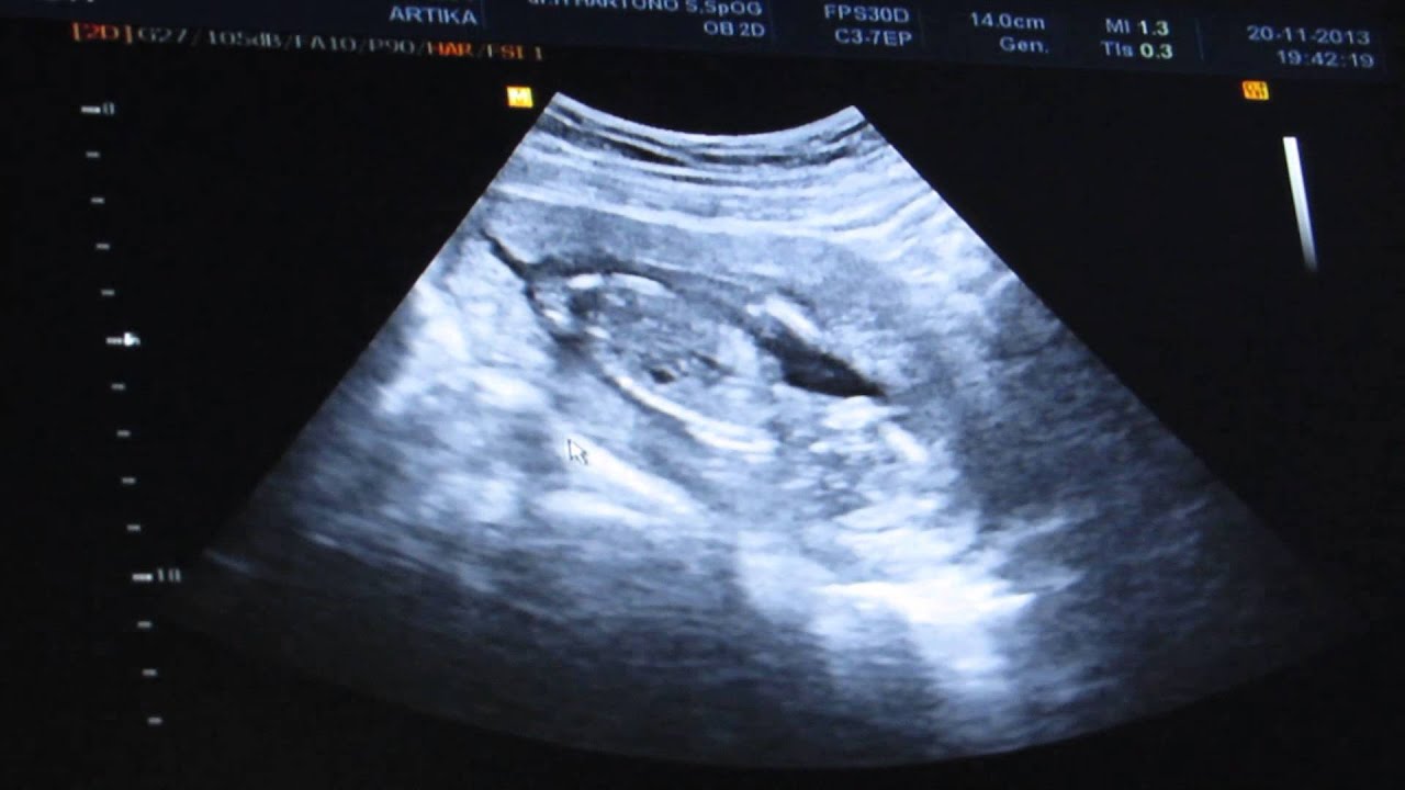  USG Kehamilan 15 minggu 20 November 2020 fetal 