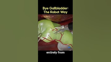 Bye Gallbladder: The Robot Way