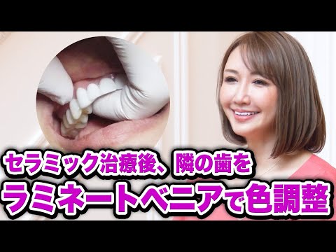 ≪世界一白い歯でセラミック矯正≫遂に完成！更に追加治療も✨そして治療その後・・・