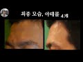 아테콜이용한 함몰이마 교정 #아테콜 #연세자연미성형외과 #벨라필#반영구필러# 이마보형물 # 이마지방이식 #신촌성형외과 #홍대성형외과 #artesense #은평성형외과 #마포성형외과