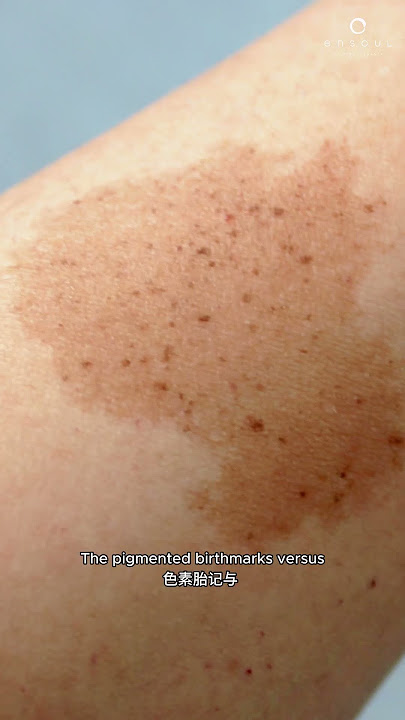 Topical Creams for Birthmarks | Ensoul Medical Clinic