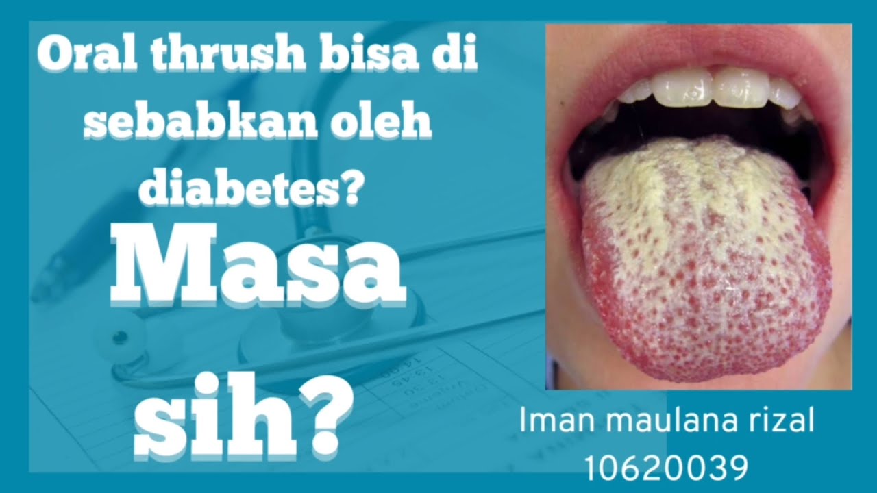 Oral thrush manifestasi penyakit sistemik Diabetes militus (DM) YouTube