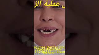إزرع أسنان بدون شق مع التلبيس خلال ساعتين. allon4 immediate loading in Lebanon 9613246317
