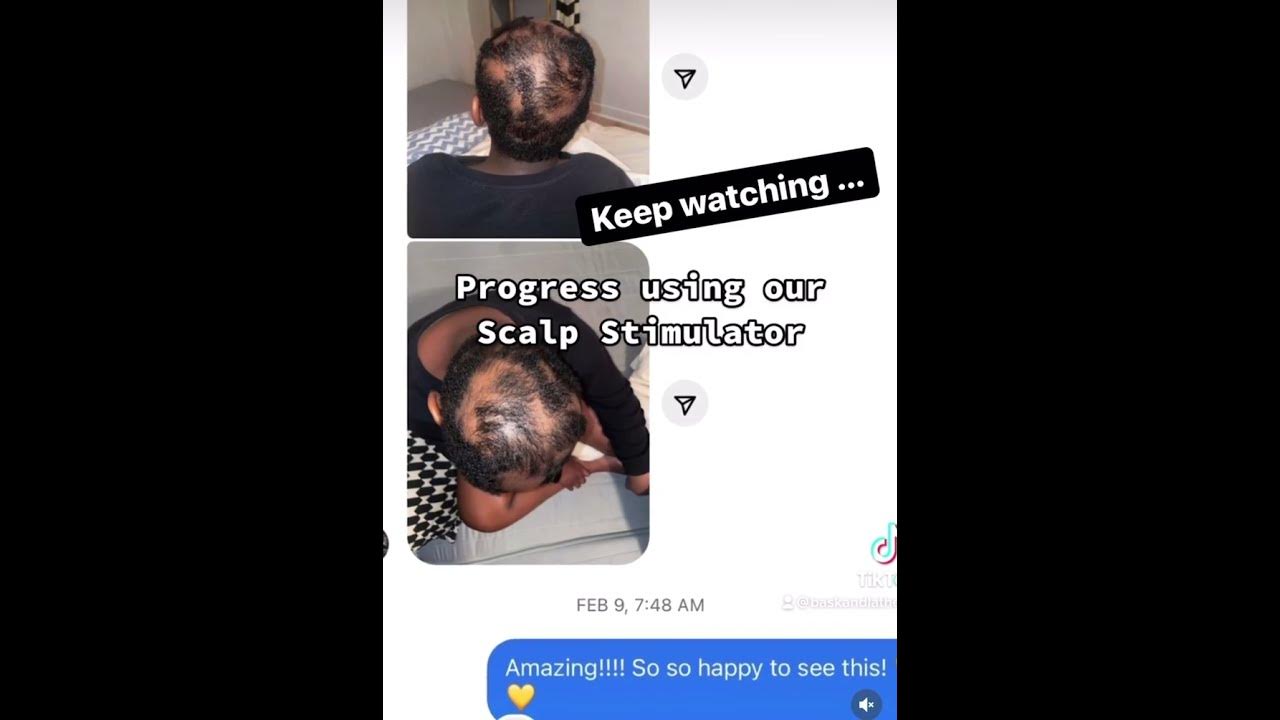 Bask and Lather Co Review Alopecia Won't Win! Real Customers, Real