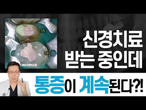 다른 곳에서 신경치료 중인데 통증이 심해요ㅠㅠ 치료를 받는데 왜 아파? 😨 다 이유가 있습니다🤦‍♂️ 뜯어보니 임시재료 마감에 신경관 아닌 곳에 구멍까지?! 깨끗하게 재치료 완료!