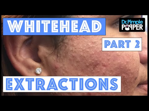 Whitehead Extractions TNTC, Session 3, Part 2 Of 2