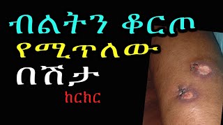 የወንድ ብልትን ቆርጦ የሚጥለው በሽታ, ከርክር, chancroid, STI screenshot 2