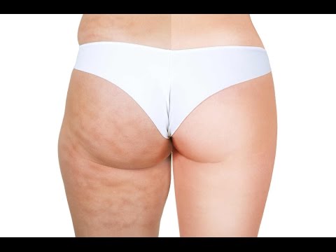 Vídeo: Vinagre De Manzana Para Celulitis