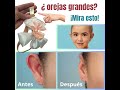 DIADEMA con soporte de adhesivo para corregir estéticamente las orejas de niños!