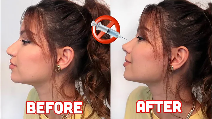 Achieve a Subtle Nose Lift with Tiny Arches - A Non-Invasive Alternative