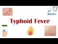 Typhoid Fever: Pathogenesis (vectors, bacteria), Symptoms, Diagnosis, Treatment, Vaccine