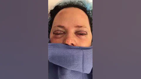 Upper and Lower Eyelid Lift Before and After! #shorts