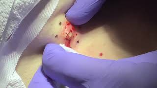 Incision and drainage of inflamed epidermoid cyst