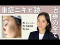 【美肌作り】これまで受けたニキビ跡治療法紹介します!
