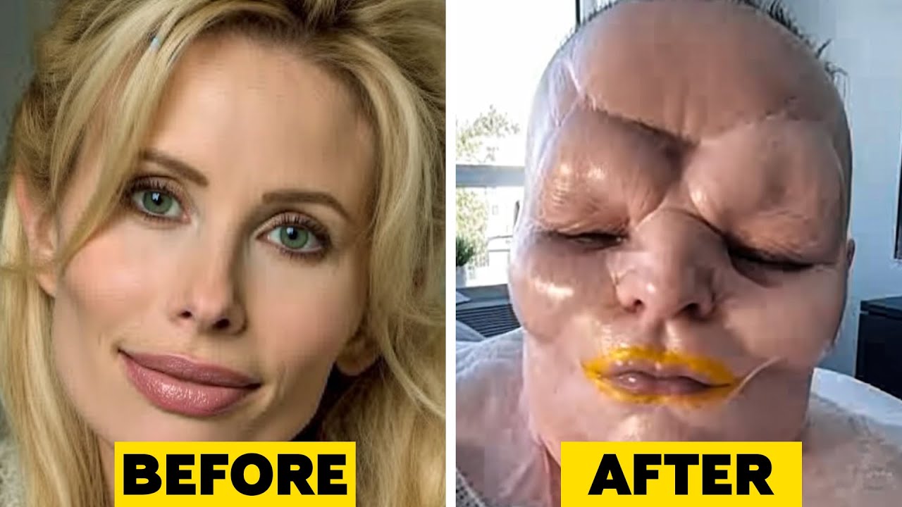⁣15 Times Plastic Surgery Went Horribly Wrong