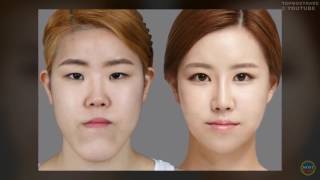 Корейская пластическая хирургия до и после 50 Фото