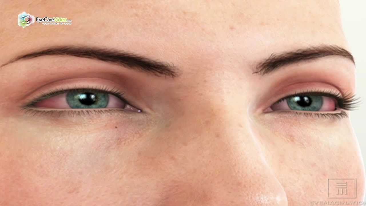 Dr. Steve Rice - Dry Eye