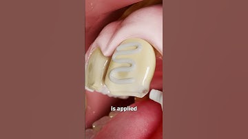 How Veneers Work 😮