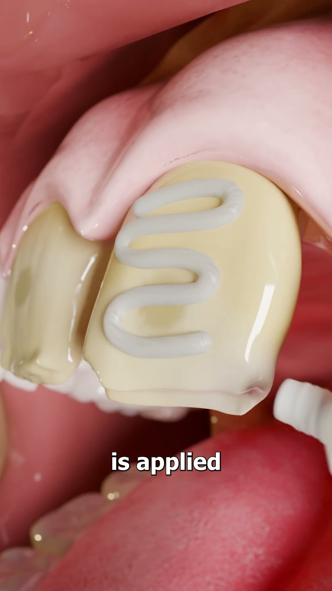 How Veneers Work ?