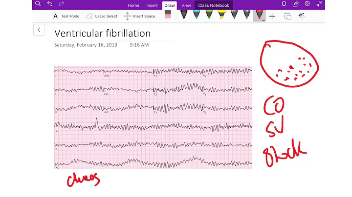 ventricular fibrillation - Dr Jamal USMLE - cardiology ECG lecture