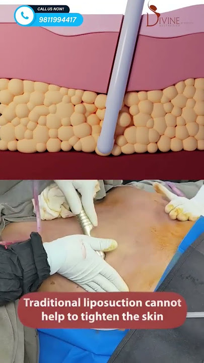 Difference Between Traditional and Vaser Liposuction | Divine Cosmetic Surgery #shorts
