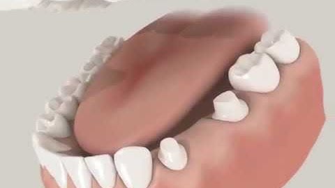 Dental Bridge animation video