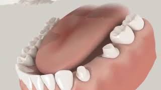 Dental Bridge Animation Video