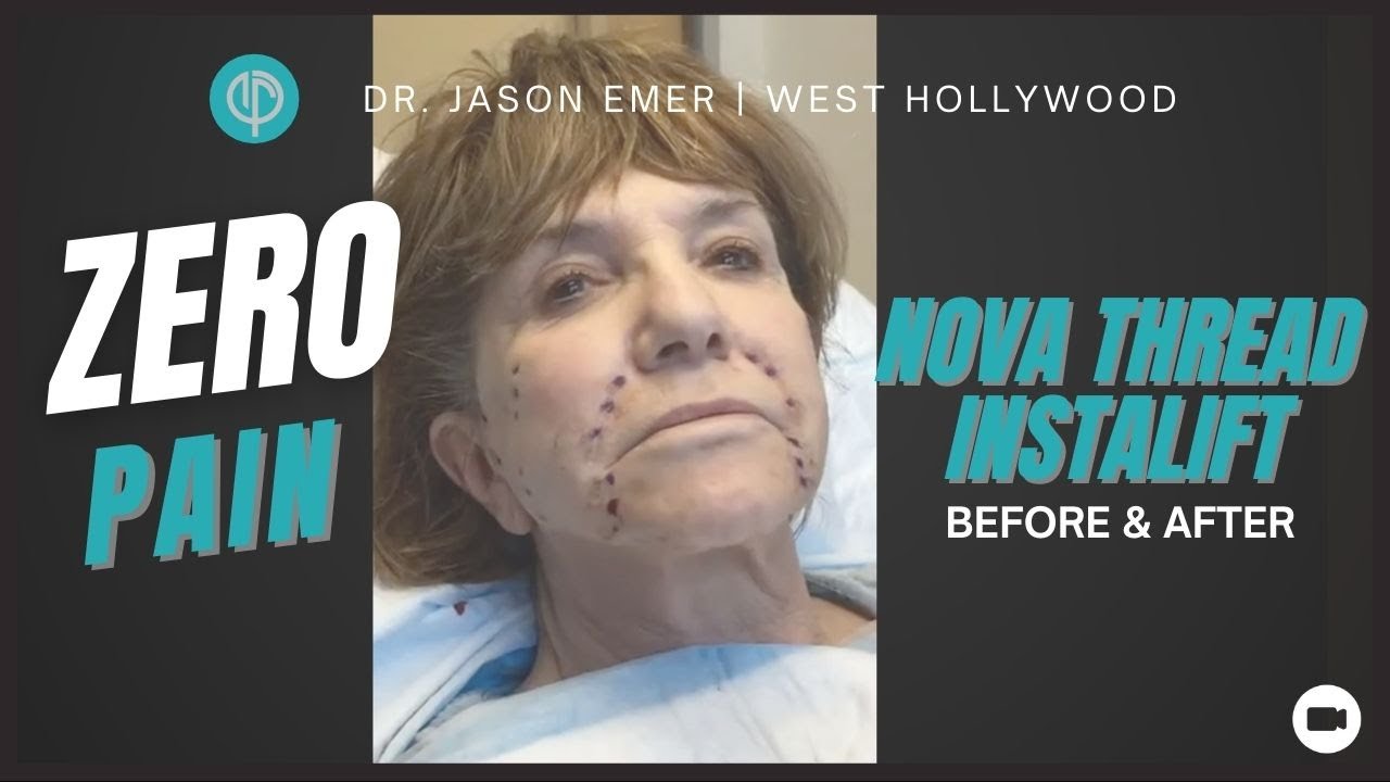 Before & After InstaLift Nova Thread Facelift Procedure ZERO Pain