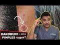 Dandruff   pimples   dr sethuraman  zi clinic