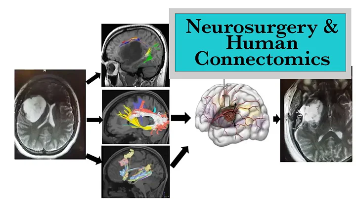 Neurosurgery & Human Connectomics - UNC Neurosurge...