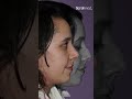 كل عملية تجميل أنف هي تحفة فنية يبدعها الدكتور بشار بزرة | افضل جراح تجميل انف في دبي ولندن