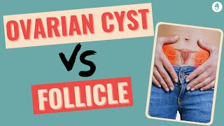 Everything about Ovarian Cysts and Follicle | Infertility Tips