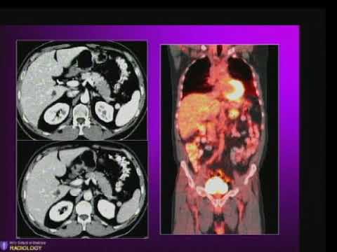 Overview of Pancreatic Imaging   CT and MR