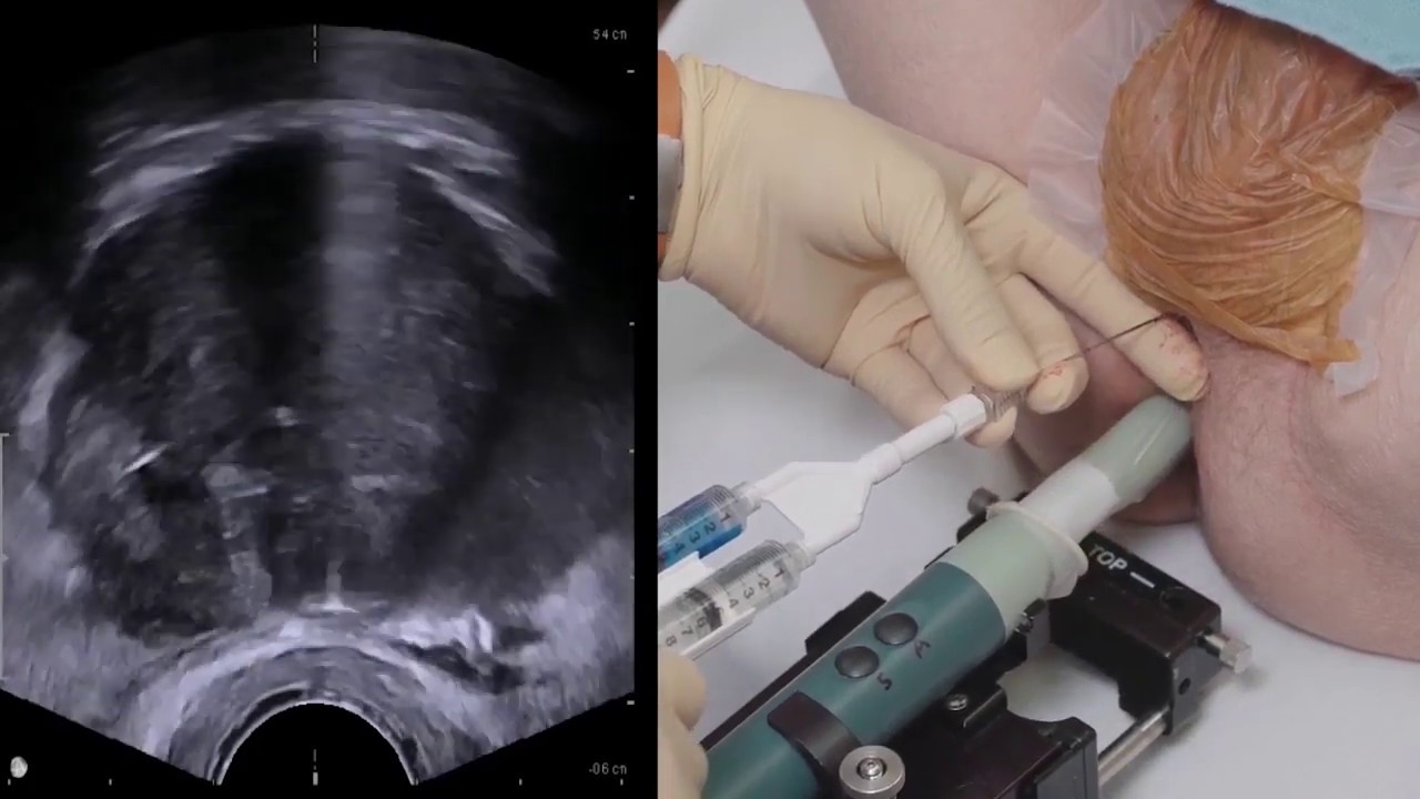  An ultrasound image of an iliac vein with a needle and a syringe next to a patient's leg with the incision site where a white gold implant is being inserted.