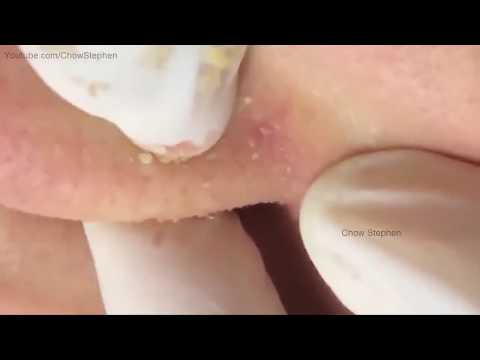 Blackheads Extraction On The Chin & Nose -  Acne Treatment
